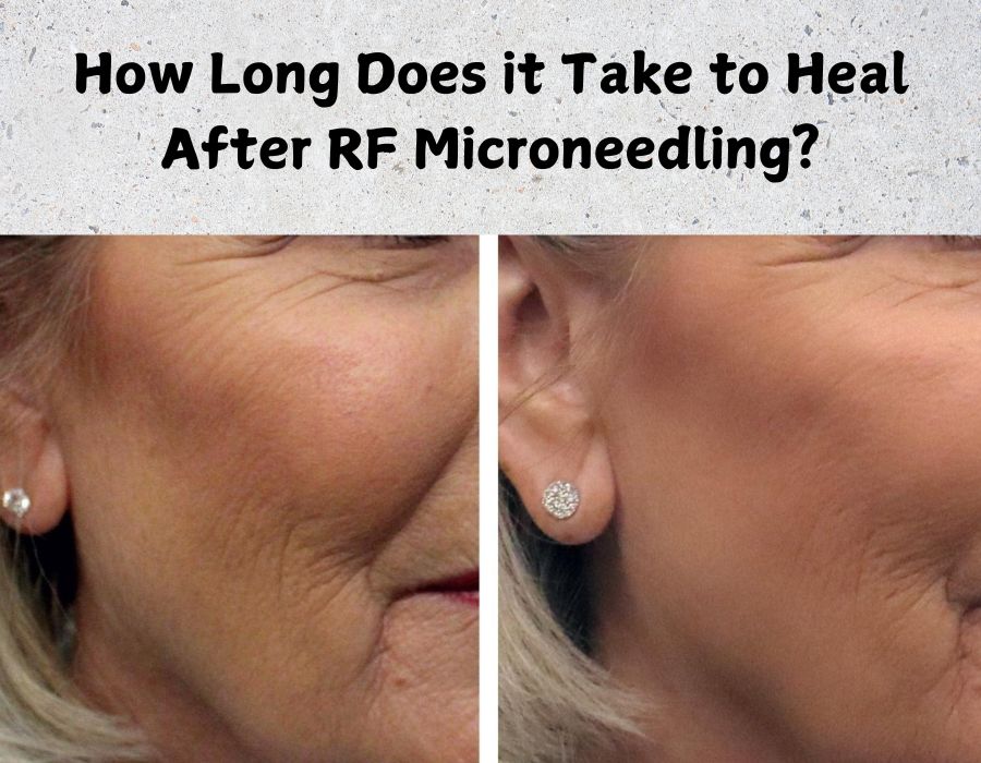 How Long Does it Take to Heal After RF Microneedling?