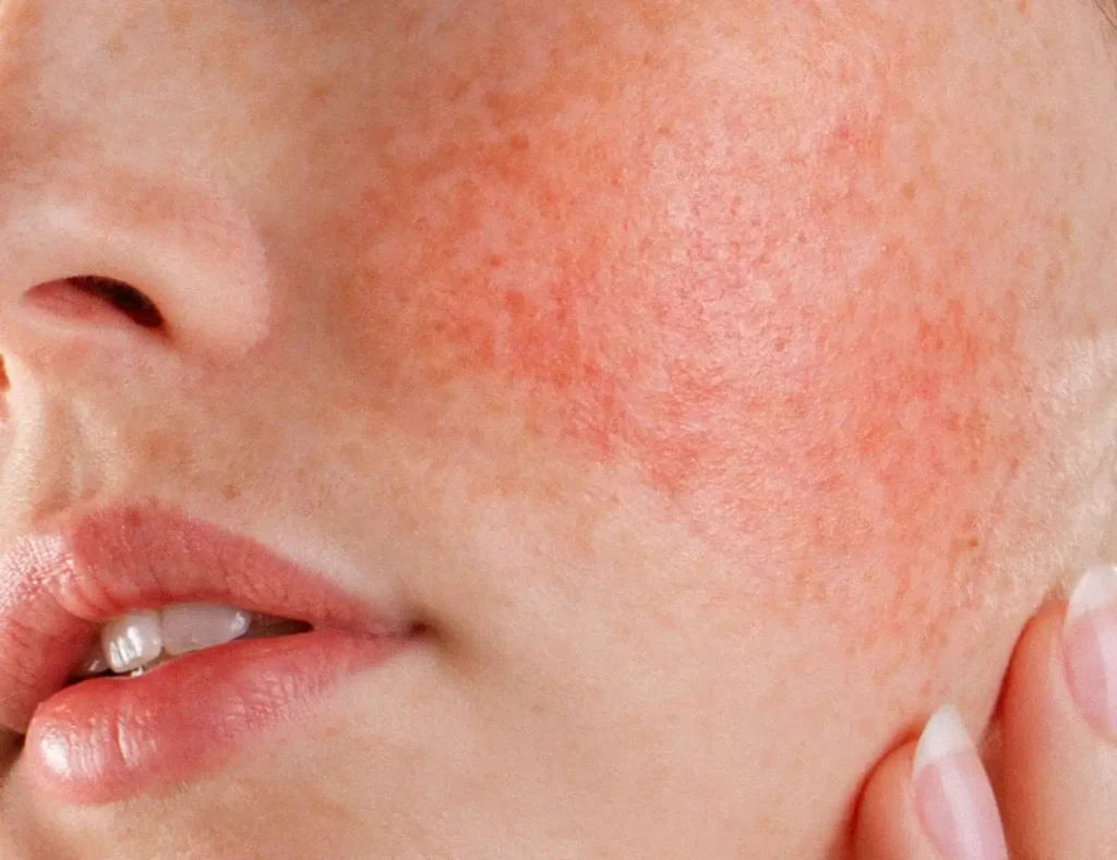 Rosacea Laser Treatment
