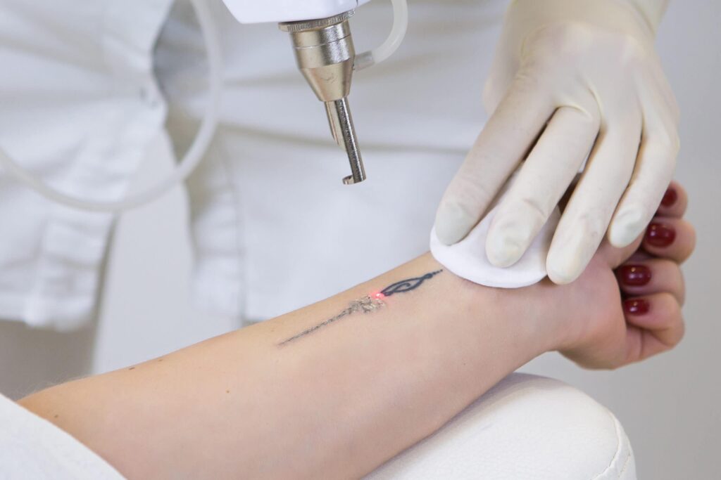 Laser Tattoo Removal Treatment Laser Tattoo Removal Treatment