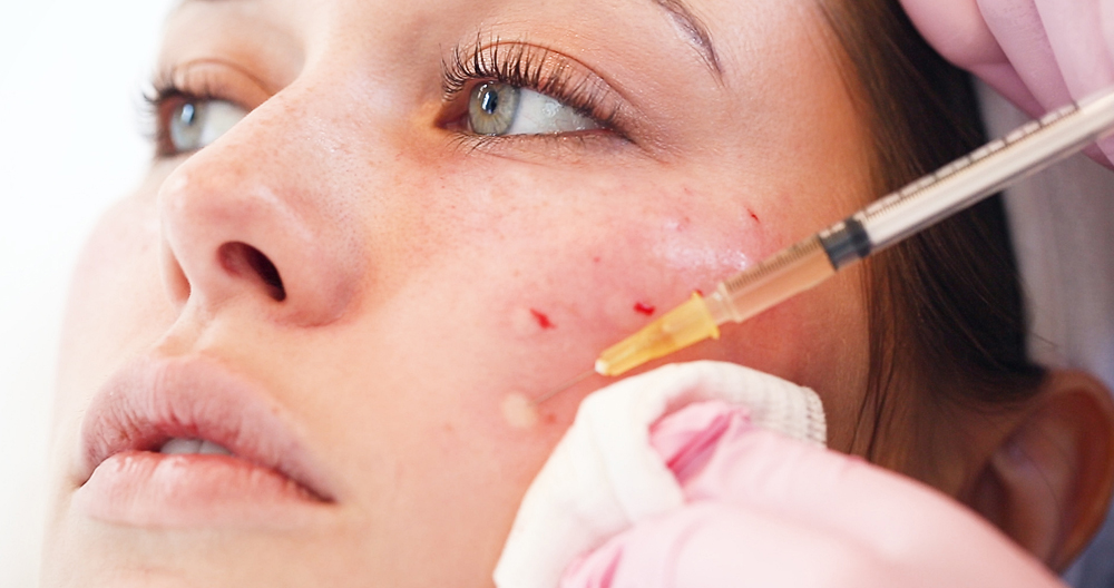 Vampire Facial Treatment Vampire Facial