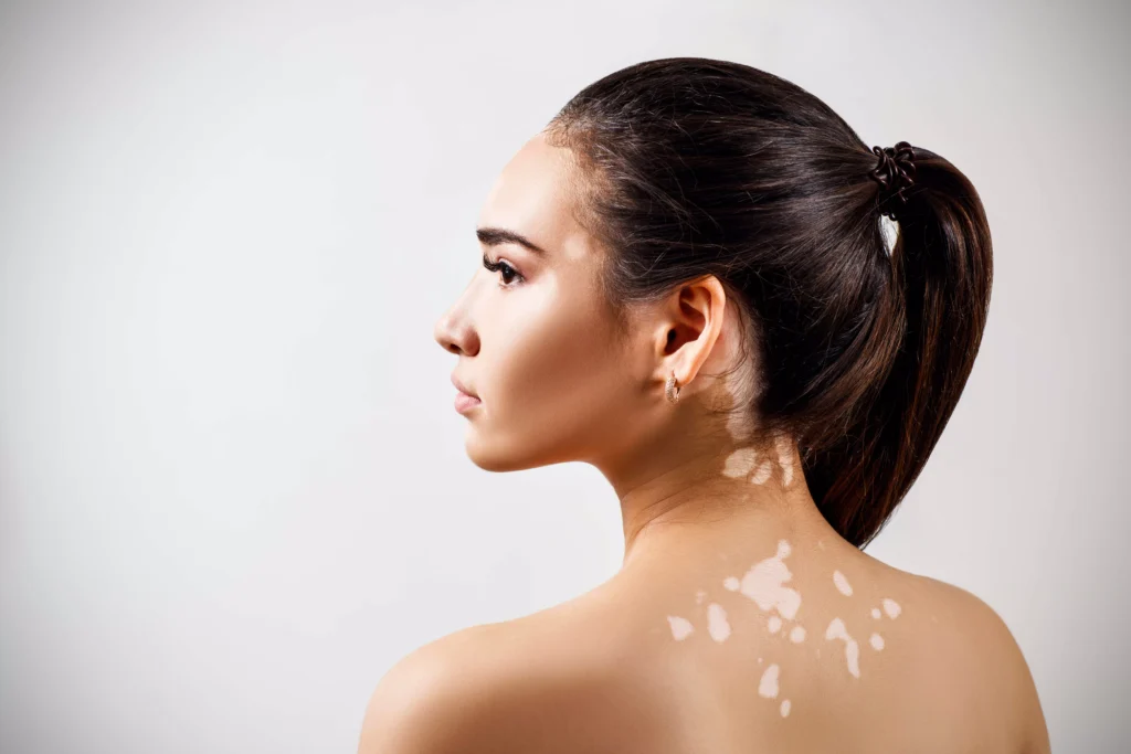 Vitiligo Laser Therapy