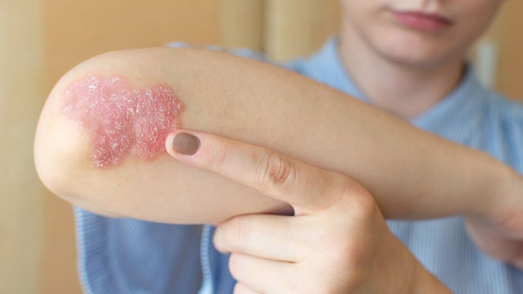 Skin Psoriasis Treatment Skin Psoriasis Treatment
