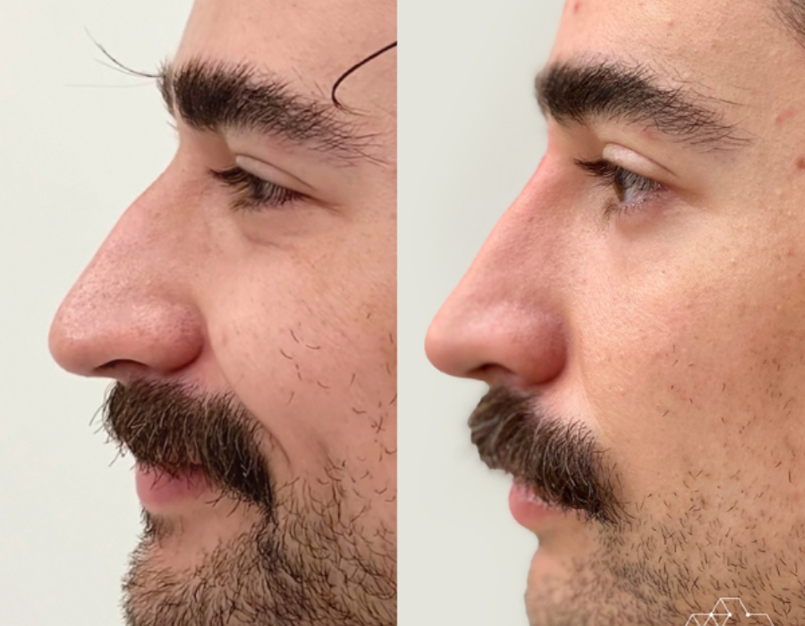 Non-Surgical Rhinoplasty in Abu Dhabi: Achieve Your Ideal Nose Without Surgery