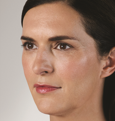 dermal fillers after