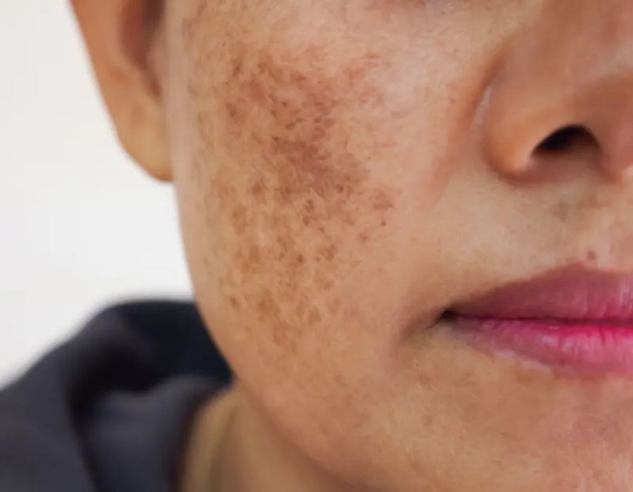 How to Treat Melasma From the Inside Naturally?