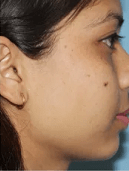 Laser-Hair-Removal-Before-and-After (1)