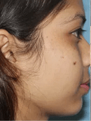 Laser-Hair-Removal-Before-and-After