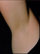 laser-hair-removal-before-after (1)