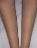 laser-hair-removal-in-abu-dhabi-before-after (1)