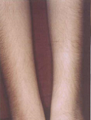 laser-hair-removal-in-abu-dhabi-before-after
